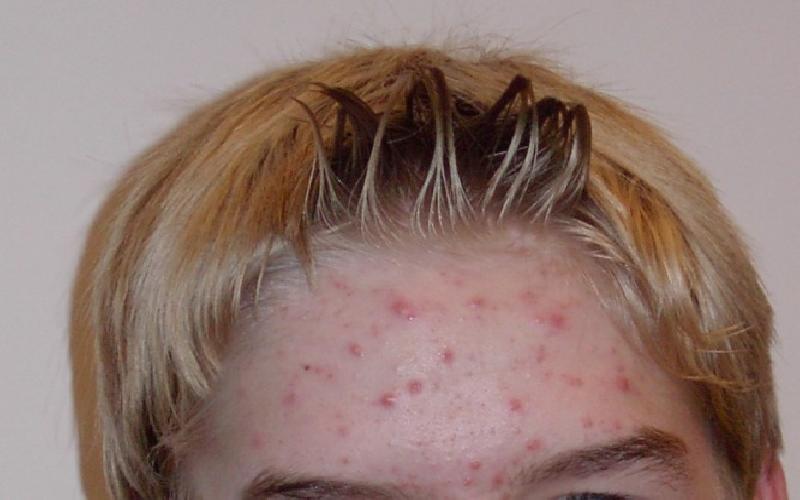 5 Natural Ways to Get Rid of Acne and Improve your Appearance