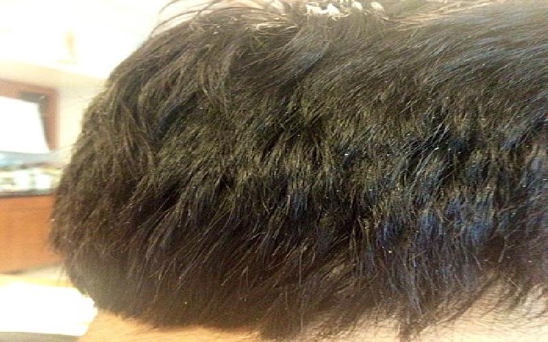 5 Best Treatments to Get Rid of Dry and Oily Dandruff and Flakes