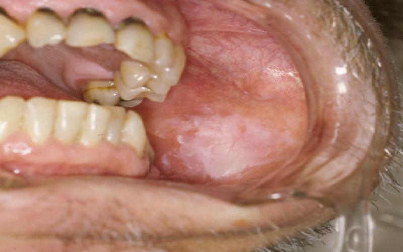 Early signs of Oral Cancer