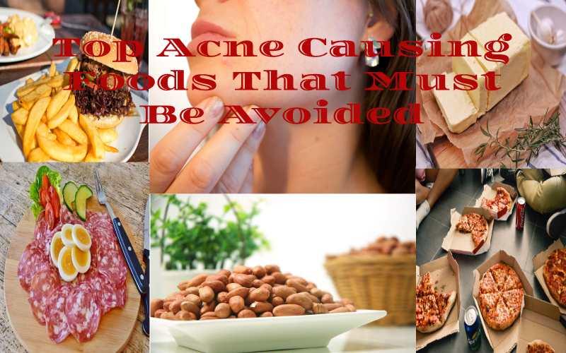 16 Prime Acne Causing Foods That Must Be Avoided