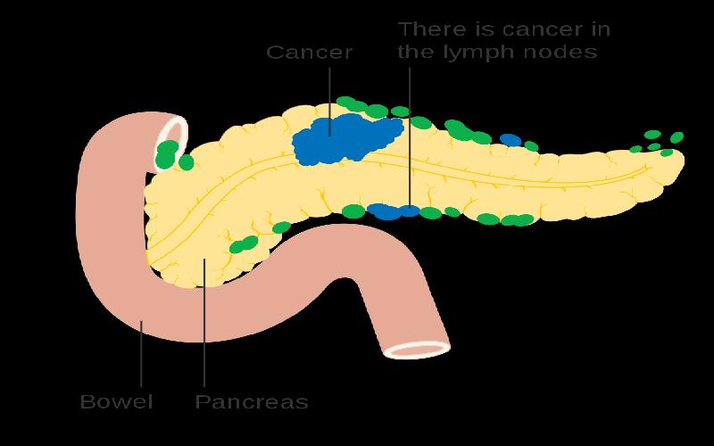 Is it Possible to Detect Early Symptoms of Pancreatic Cancer?