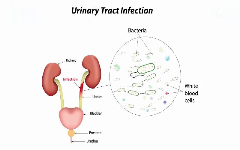 Uti Symptoms - Urinary Tract Infection During Pregnancy Can Cause Miscarriage